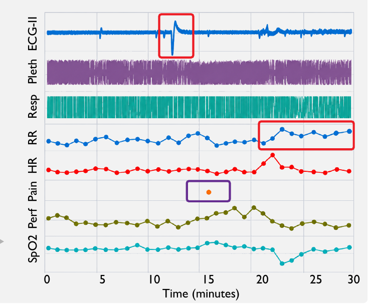 A 30-minute window of ECG-II, plethysmography, respiration, respiratory rate, heart rate, pain score, perfusion, and SpO2.