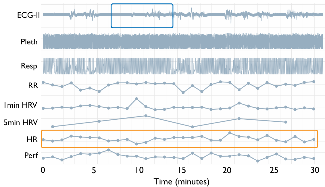 A 30-minute clinical window: ECG-II, plethysmography, respiration, respiratory rate, 1- and 5-minute HRV, heart rate, and perfusion.